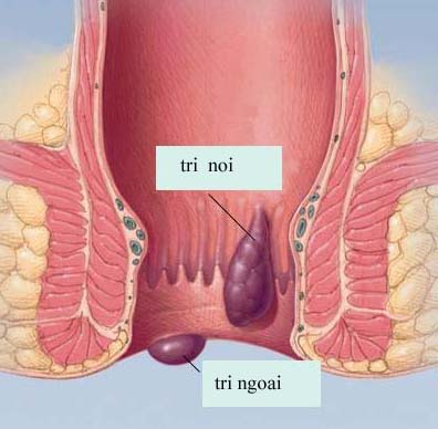 Uống Ovata, chia tay bệnh trĩ 1