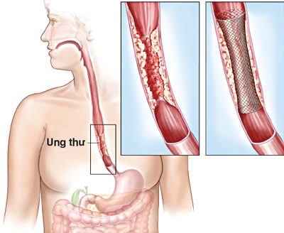Cảnh giác khi nuốt khó 1 Cảnh giác khi nuốt khó 1