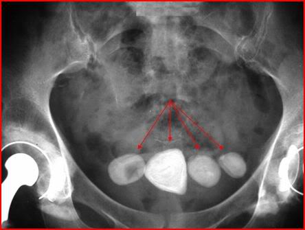 Nhịn tiểu thường xuyên mắc bệnh gì? 1