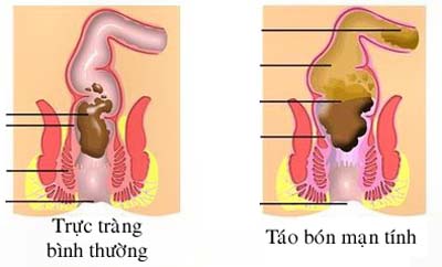 Những hệ lụy do lạm dụng thuốc tẩy trị táo bón 1 Những hệ lụy do lạm dụng thuốc tẩy trị táo bón 1