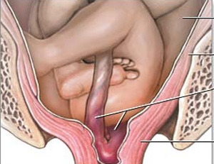 Sa dây rốn - Nguy cơ  cao đối với thai nhi 3