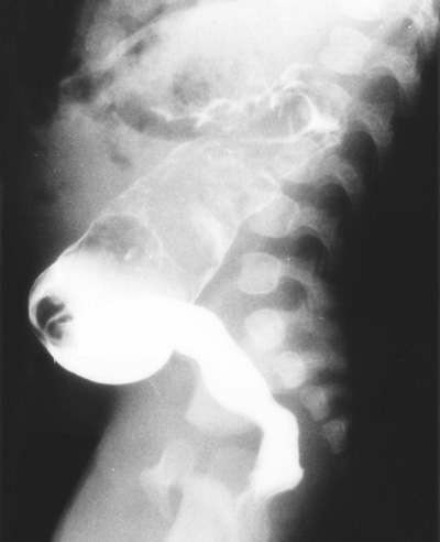 Thế nào là bệnh Hirschsprung? 2 Thế nào là bệnh Hirschsprung? 2