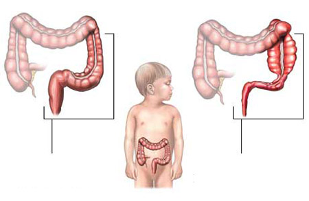 Thế nào là bệnh Hirschsprung? 1 Thế nào là bệnh Hirschsprung? 1