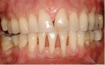 Co lợi, bất lợi cho răng 1 Co lợi, bất lợi cho răng 1