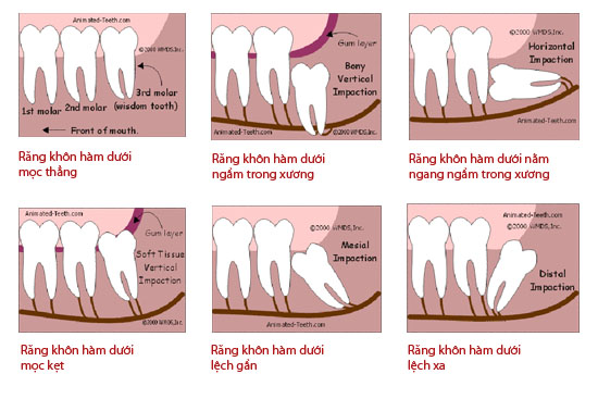 Răng khôn mọc kẹt 1