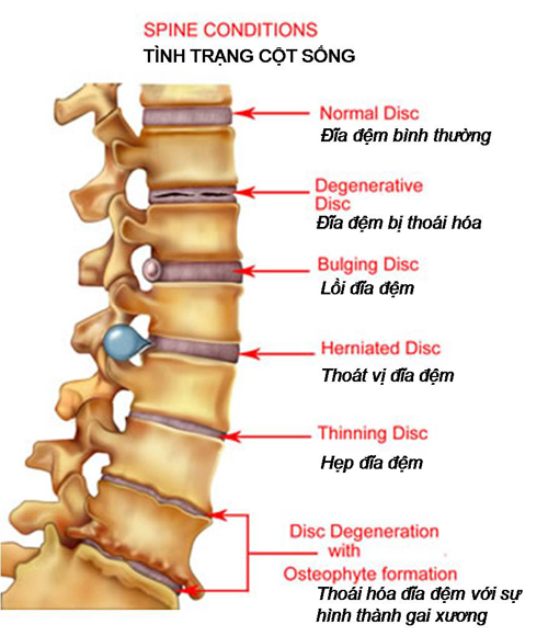 Nguyên nhân, biểu hiện và cách phòng bệnh đau thần kinh tọa 1