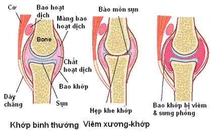 Thay đổi quan điểm sử dụng đối với thuốc chống viêm khớp 1 Thay đổi quan điểm sử dụng đối với thuốc chống viêm khớp 1