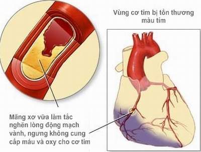 Khuyến cáo đặc biệt khi dùng thuốc điều trị nhồi máu cơ tim 1