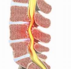 Nguy hiểm khi bị hẹp ống sống 2