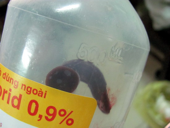 Tắm suối bị vắt chui vào hốc mũi  1
