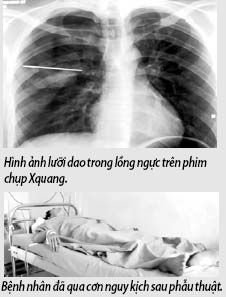 Thoát chết sau khi bị dao đâm gãy trong lồng ngực 1 Thoát chết sau khi bị dao đâm gãy trong lồng ngực 1