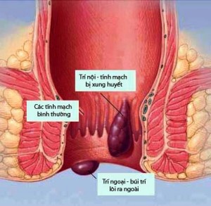 Liệu pháp tối ưu với người bệnh trĩ 1