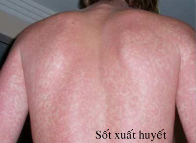 Thuốc dự phòng huyết khối: Sự thận trọng cần thiết 2