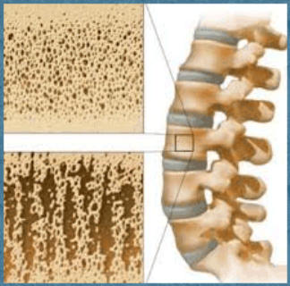 Vì sao glucocorticoid gây loãng xương? 1