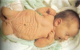 Hội chứng mất cơ bụng là gì? 1