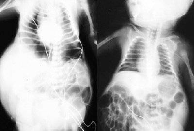 Hội chứng mất cơ bụng là gì? 2