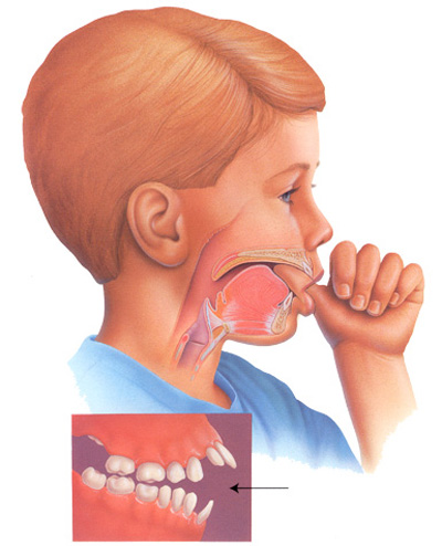 Khi nào cần đưa trẻ đi nắn chỉnh răng? 1
