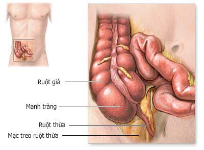 Cảnh giác với biến chứng viêm ruột thừa cấp 1