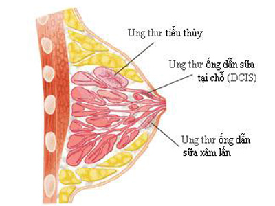 Ung thư vú và thai nghén: Những điều cần biết 1 Ung thư vú và thai nghén: Những điều cần biết 1