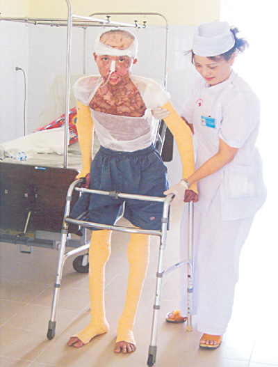 Điều trị di chứng và phục hồi chức năng do bỏng 1 Điều trị di chứng và phục hồi chức năng do bỏng 1