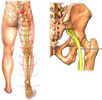 Ðau thần kinh hông có phòng được không? 1 Ðau thần kinh hông có phòng được không? 1