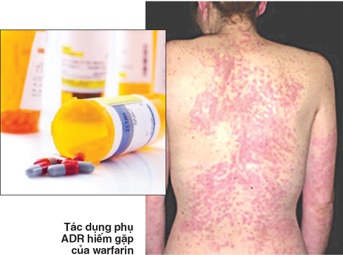 ADR: phản ứng có hại của thuốc 1