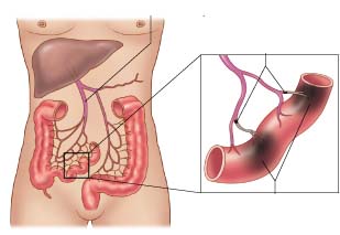 Huyết khối tĩnh mạch mạc treo - Bệnh dễ nhầm, hay tái phát 1