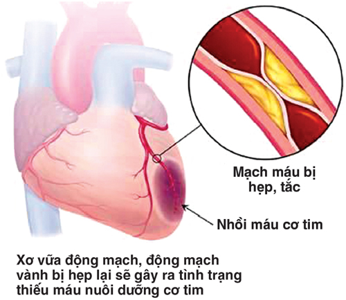 Đau thắt ngực và thiếu máu cơ tim 1