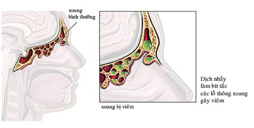 Thuốc trị viêm mũi xoang mùa hè 1