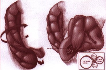 Biến chứng nguy hiểm do xoắn đại tràng 1