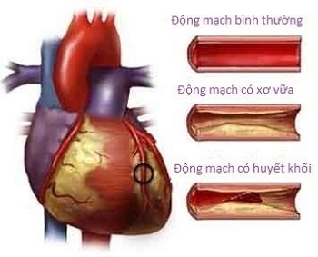 Cách phòng ngừa nhồi máu cơ tim 1