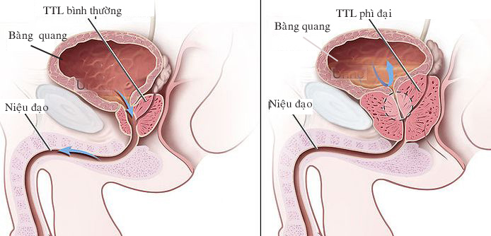 Ðề phòng nhiễm khuẩn đường tiết niệu do u xơ 1