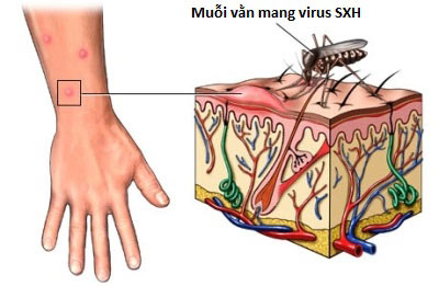 Phát hiện và chăm sóc trẻ sốt xuất huyết tại nhà 1