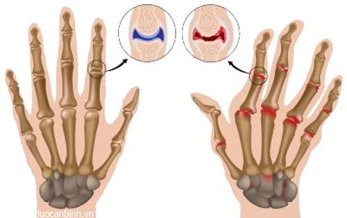 Thoái hóa khớp bàn tay và cách phòng ngừa 1