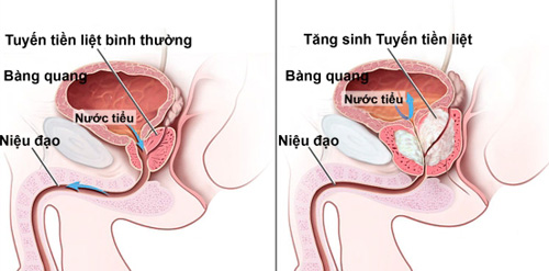 Bệnh của tiền liệt tuyến 1