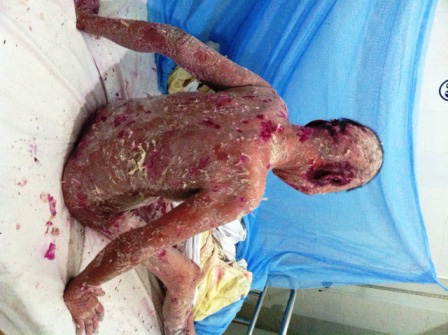 Cứu sống “thần kỳ” bệnh nhân bị bong tróc da toàn thân 1