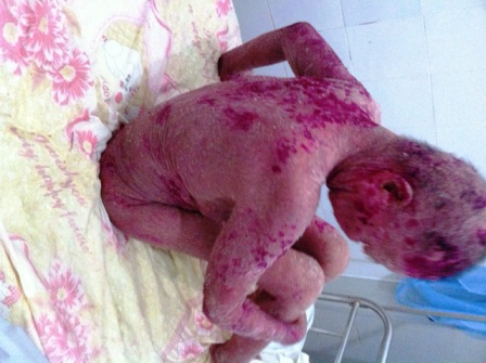 Cứu sống “thần kỳ” bệnh nhân bị bong tróc da toàn thân 3