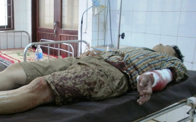 Chủ quán nhậu bị côn đồ chém gần lìa cánh tay	 1