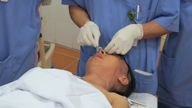 Phẫu thuật cho người 30 năm không há được miệng 2