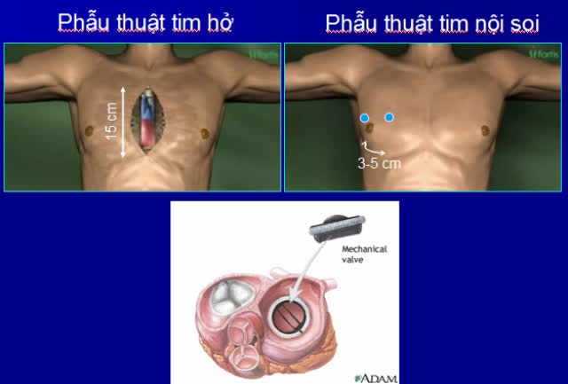 Lần đầu tiên phẫu thuật nội soi tim thành công 3