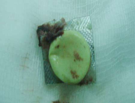 Suy kiệt, nôn ra máu vì uống thuốc còn vỏ 1