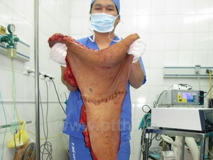 Cắt bỏ thành công khối u cho cô gái mang "mai rùa" 1