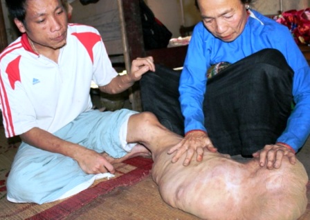 Cắt bỏ khối u hơn 10kg đeo trên chân 1