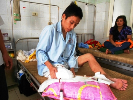 Cắt bỏ khối u hơn 10kg đeo trên chân 2