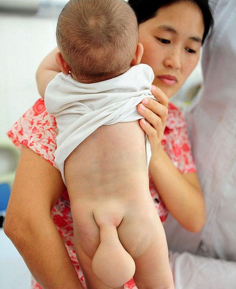 Bé trai 7 tháng tuổi có 'đuôi' 1