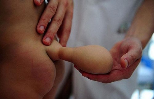 Bé trai 7 tháng tuổi có 'đuôi' 2