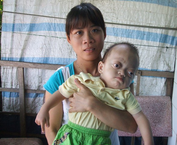 Cứu bé mắc bệnh “lồi mắt” hiếm gặp 1