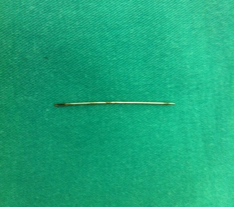 Lấy thành công chiếc kim dài 4,5cm ra khỏi tim bệnh nhân 1