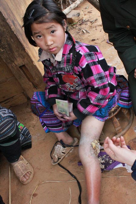 Bé gái 3 năm sống với cái chân lúc nhúc giòi 1