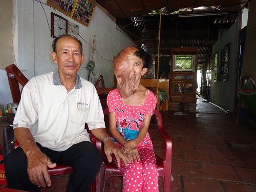 Cô gái hơn 2 thập kỷ sống với mũi, tai, miệng... chảy dài xuống ngực 2